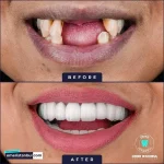 Full dental treatment Turkey