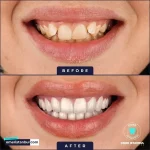 Gum treatment Istanbul