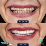Hollywood smile Turkey