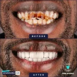 Zirconium veneers in Turkey