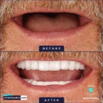 dental implant before and after
