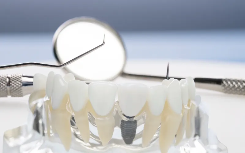 Diş İmplantı Sökülebilir Mi?