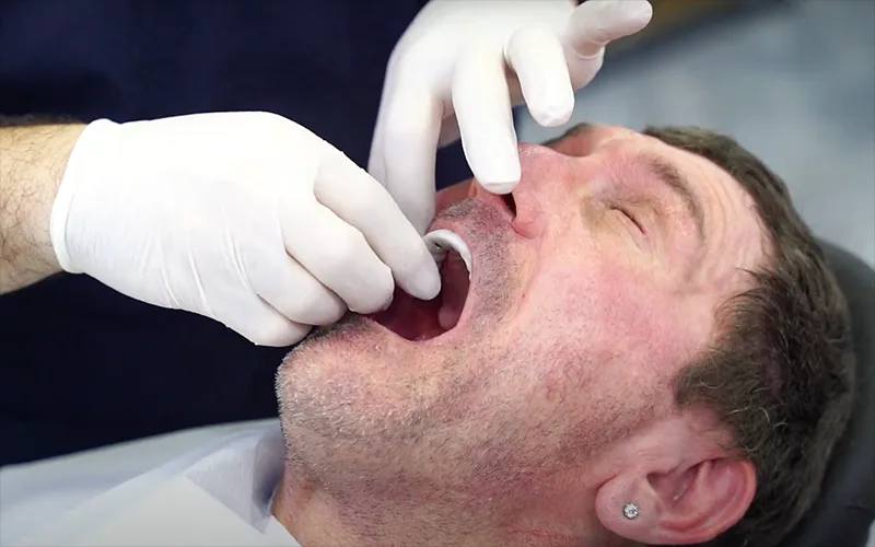 All On Four İmplant Tedavisi Sonrası Nelere Dikkat Edilmeli?