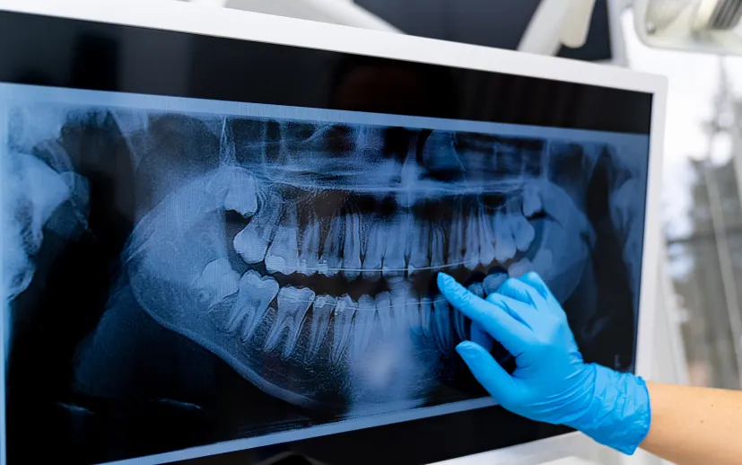 Şeker Hastalarına İmplant Diş Yapılır Mı?