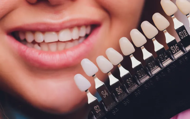 Lamina Diş Kaplama Kaç Günde Yapılır? 