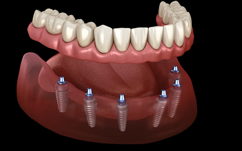 Komple İmplant Tedavisi Nedir?