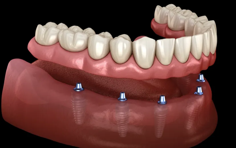 Hiç Dişi Olmayana Kaç İmplant Gerekir?