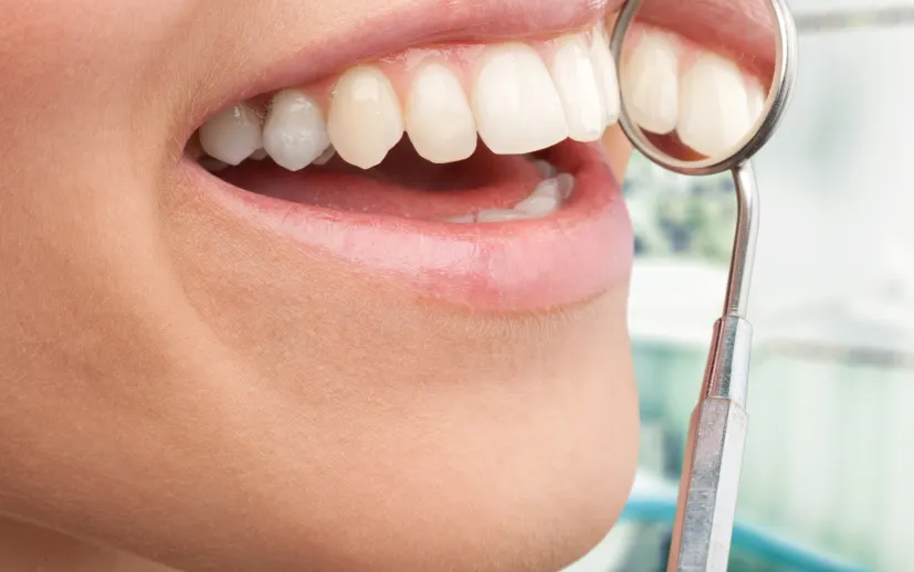 Diş Kaplama Sonrası Dikkat Edilmesi Gerekenler